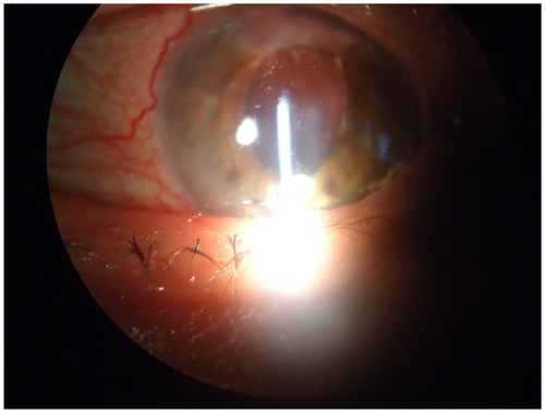 Figure 1 Anterior segment details – conjunctival hyperemia and anterior chamber intraocular lens (LEFT EYE).