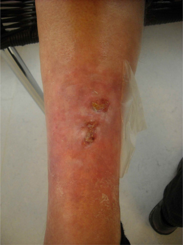Figure 4 Leg lesion upon follow up.