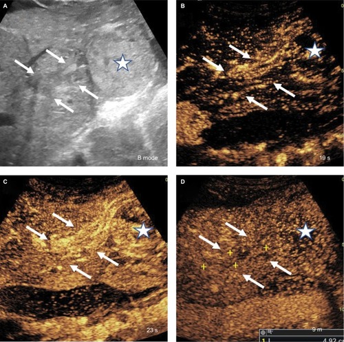 Figure 11 CEUS LI-RADS TIV.• Unequivocal arterial phase hyperenhancement and washout of soft tissue within the lumen of portal and/or hepatic veins.• Must correspond on dual screen with mass in vein.• Most LR-TIVs are HCC. Some are iCCA or cHCC-CCA.• CEUS has been shown to have high sensitivity and specificity to diagnose TIV.