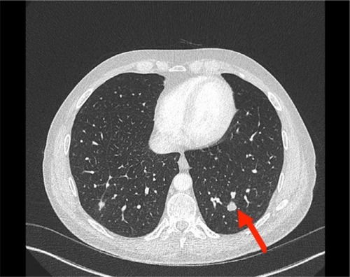 Figure 2 Abdomen–pelvis CT scan showing metastasis in left lung base.