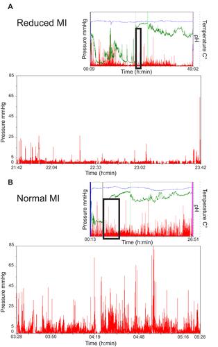 Figure 1 WMC recordings showing temperature (blue tracing), pH (green) and pressure recordings (red), time of ingestion (blue vertical line), gastric emptying (grey vertical line), ileocecal junction (green vertical line) and capsule expulsion (pink vertical line). Isolated pressure recordings from the two first hours of the small bowel from each recording are enlarged below. The MI is expressed as mmHg*seconds/minute and is calculated as the summed area under the amplitude curve for contractions >10mmHg, divided by the time window used. Calculation was performed using the MotiliGI® software. (A) WMC results from a patient with impaired small bowel MI. (B) WMC results from a patient with normal small bowel MI.