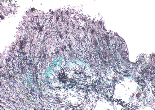 Figure 2 Photograph of extraction of concretion and Histopathological micrograph of the extracted concretion. PAS staining reveals thin filamentous masses over a wide area, suggesting the presence of Actinomyces.