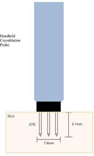 Figure 2 A 3-pronged cryoablation device (with three 27-g needles, approximately 7.6 mm in length) was used along the treatment line shown in Figure 1, moving circumferentially to cover the entire cross-section of the ICBN. Multiple cycles of cryotherapy lasting 60 s in the treatment line as described above were administered with three 27-g needles at a depth of approximately 5.1 mm. The tips of the three-prong needle achieved a cooling temperature of maximum −88 degree Celsius.