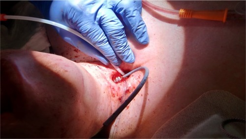 Figure 11 By tearing both ends of the jagwire and bending the straight part of the y-stent outward, the upper half of the FS is flipped over the jagwire into the upper third of the ruptured trachea.