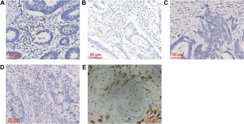 Figure 2 Immunohistochemical staining images of CD3+ lymphocytes (A), CD4+ lymphocytes (B), CD8+ lymphocytes (C), CD20+ lymphocytes (D) and CD68+ macrophages (E). 400× magnification.