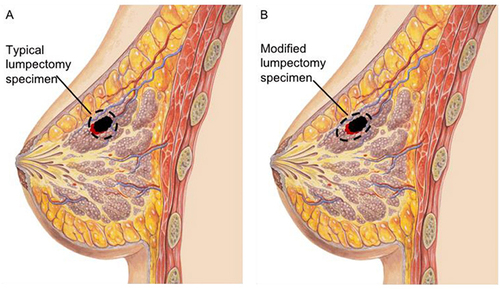 Figure 3 Lateral view of the breast highlighting: (A) traditional spherical resection of tumor, (B) recommended elliptical resection in the nipple-ward direction.