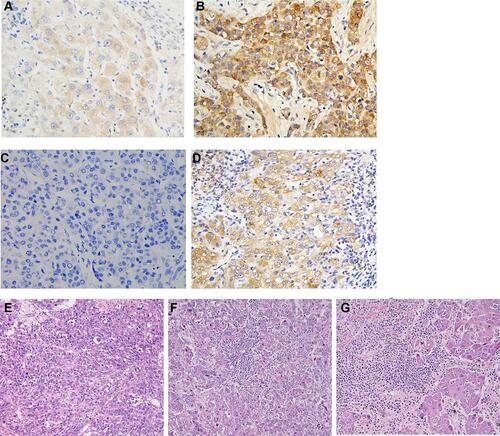 Figure 2 Expression of HHLA2 and PD-L1 and density of TILs in HCC tissues. Representative micrographs of low HHLA2 expression (A) and high HHLA2 expression (B) within HCC tumors. Representative micrographs of negative PD-L1 expression (C) and positive PD-L1 expression (D) within HCC tumors. Representative H&E staining of TILs in HCC tissues. Samples were graded as showing low TIL density (E), intermediate TIL density (F) or high TIL density (G).