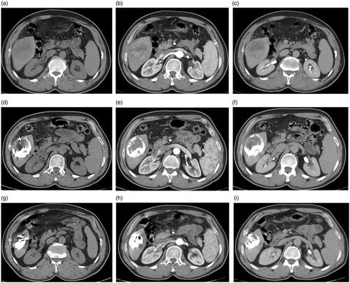 Figure 6. A 60-year-old man with a history of antiviral treatment for hepatitis C virus. Contrast-enhanced CT before treatment: (a) pre-contrast, (b) arterial, and (c) delayed phases show a single 4.8-cm focal lesion at segment VI with HCC criteria (arterial enhancement and delayed washout). TACE was performed and results of follow up contrast-enhanced CT after 12 months are shown: (d) pre-contrast, (e) arterial, and (f) delayed phases show complete response with no significant enhancement or washout. Follow-up contrast-enhanced CT after 24 months are shown: (g) pre-contrast, (h) arterial, and (i) delayed phases show complete response with a significant decrease in the size.
