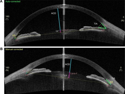 Figure 1 Location of TIA, ACD and LV is shown in an SS-OCT image. The ICA tool is shown which had to be placed manually on the scleral spur by the operator which then displayed the lines measuring the anterior chamber morphometric data displayed in the tables. (A) An open anterior chamber. (B) Angle closure with shallow ACD. In both images, TIA is displayed in green, ACD in blue and LV in pink.