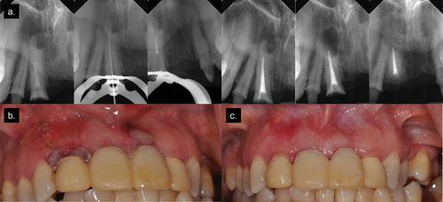 Figure 2. (a) Retreatment and surgical radiographs; (b) 3-day post-operative clinical photograph; (c) 6-week post-operative clinical photograph.