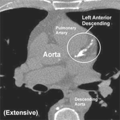 Figure 4 Extensive calcifications, warranting aggressive medical management for atherosclerosis.