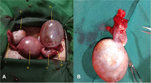 Figure 2 Intraoperative finding (A) showing normal right fallopian tube (i), normal right ovary (ii), gravid uterus (iii), left ovarian cyst (iv), left tubal ectopic pregnancy (v), and ruptured fimbrial end with active bleeding (vi), and surgical specimen (B).