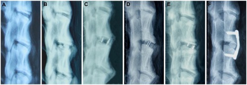 Figure 2 The different instrumentation techniques tested in the study. Depicted are lateral radiographs of sheep cervical spine (C2–C5) with the different instrumentations from left to right: (A) native sheep cervical spine; (B) bone graft; (C) Medtronic cage; (D) Solis cage; (E) BCFC device; (F) bone graft plus ACP.Abbreviations: BCFC, bioabsorbable, self-retaining cervical fusion cage; ACP, anterior cervical plate.