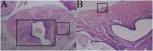 Figure 7. (a)DIE (HE × 40). (b) DIE (HE × 100).DIE: The ectopic lesion was located in the subperitoneum, and the glands were mainly small in size; there were occasionally large glands as well as glands surrounding stromal cell aggregates, as indicated in (a) marker ①; the lesion was mainly composed of smooth muscle tissue, as indicated in (a) marker ②; and the peritoneal mesothelial tissue structure was destroyed, with a small amount of peritoneal mesothelial tissue visible, as indicated in (b) marker ①.
