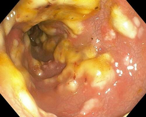 Figure 5 Colonoscopy image of case No. 3.