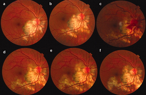 Figure 1. Fundus photographs of serpiginous choroiditis. Progression despite anti-tuberculous treatment (ATT) with oral prednisone (a–d). Papillo-phlebitis developed after 1 month ATT commencement (c). Exacerbation after mycophenolic acid was added (e). Remission after 1 month with adalimumab (f).