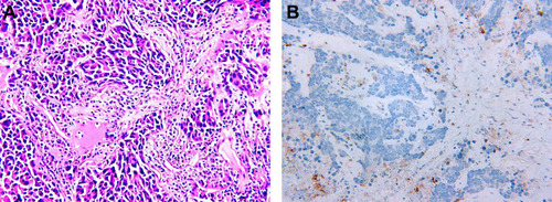 Figure 4 Immunohistochemical staining of primary tumor in lung for PD-L1. (A) Hematoxylin-eosin staining of the tumor tissue (200X). (B) Immunohistochemical staining for PD-L1 (Negative, 200X).