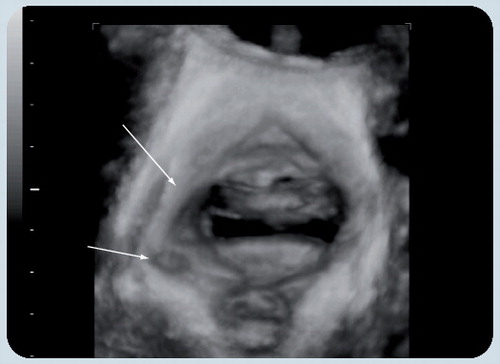 Figure 7. Typical right-sided avulsion injury in a rendered volume, axial plane.It is evident that the pelvic sidewall is smoothly denuded of muscle, that is, that the morphological abnormality documented here is an ‘avulsion’ of the puborectalis muscle insertion.Reproduced with permission from Citation[61].