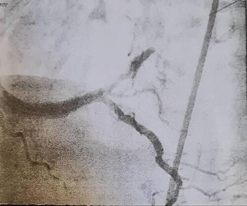 Figure 2 CT angiogram showing right coronary artery lesion.