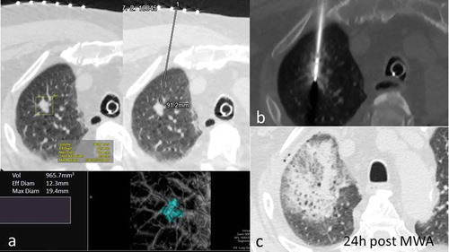 Figure 1. 68y-year-old male with biopsy proven RUL adenocarcinoma. a. volumetric assessment of target lesion and planned trajectory for MWA antenna. b. antenna in situ, 4min 30sec ablation cycle c. 24-hour CT scan showing extent of thermal damage with mixed consolidation and ground-glass opacity around target lesion.