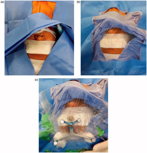 Figure 1. (a) During the draping the patient's forehead and eyes are exposed, and eyebrows are covered with sterile gauze to protect them from adhesive surgical film. (b) Exposed forehead is covered by transparent surgical film. (c) Mount reference frame on the forehead and fix it firmly with fragmented surgical film.