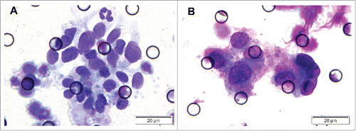 Figure 2. CTM in patients with NPC. A-B, samples of CTM in 2 NPC patients.
