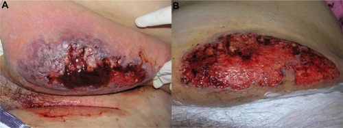 Figure 2 (A) Ulcerative stage of classical and rapidly progressive pyoderma gangrenosum ulcer, showing an elevated, violaceous, undermined border, with a necrotic and hemorrhagic base. (B) The healing stage ulcer, 3 months after systemic therapy, presenting the “Gulliver” sign; ulcer base containing granulation tissue, and necrotic tissue in a lesser extent.
