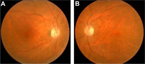 Figure 1 Right (A) and left (B) fundus photographs showing diffuse optic disc pallor in both eyes.