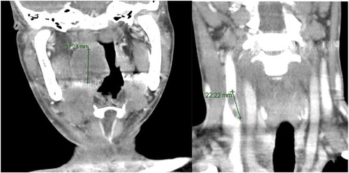 Figure 2. (a, b): CT neck coronal section (a) abscess in the right palatine tonsil. (b) Non-occluding thrombus in the right internal jugular vein.