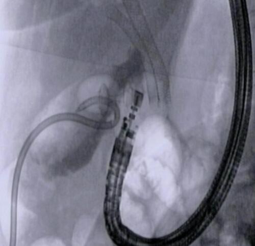 Figure 7 Fluoroscopic view of a conversion procedure, from percutaneous transhepatic gallbladder drainage (PTGBD) to endoscopic ultrasound-guided gallbladder drainage (EUS-GBD) with the positioned electrocautery lumen apposing metal stent (EC-LAMS) into the gallbladder lumen.