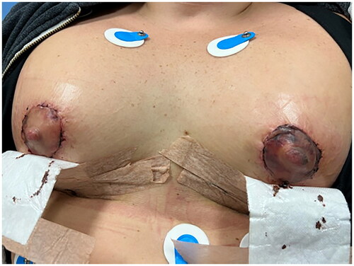 Figure 1. Photograph of patient’s breasts demonstrating periareolar incisions.