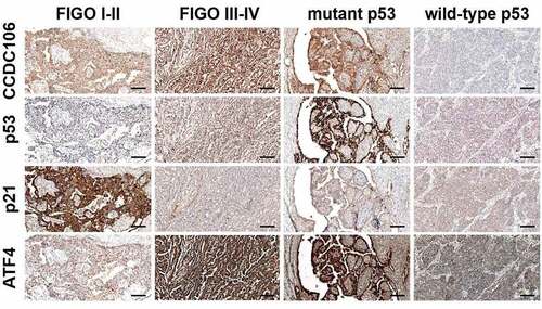 Figure 9. Immunohistochemical analysis of CCDC106, p53, p21 and ATF4 expression levels in ovarian cancer tissues. CCDC106, p53 and ATF4 were weakly expressed in FIGO I-II stage ovarian cancer samples while p21 was positively expressed. In FIGO III-IV stage and mutant p53 ovarian cancer samples, CCDC106, p53 and ATF4 were positively expressed in the nucleus and cytoplasm, respectively, while p21 was weakly expressed in FIGO III-IV stage and in mutant p53 ovarian cancer samples. Scale bars = 50 μm.