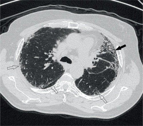 Figure 2 High-resolution CT scan of the chest showing features of UIP, including peripheral reticulation (open arrows) and honeycombing (closed arrow).