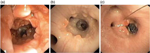 Fig. 5 Chronic study: (a) Day 14 – after removal of proximal stent, and polyps are seen, (b) Day 18 – same area 4 days later showing dramatic healing and (c) Day 18 – view of the residual distal stent.