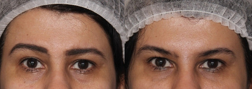 Figure 5 Before and after OnabotulinumtoxinA treatment for the correction of eyebrow asymmetry.
