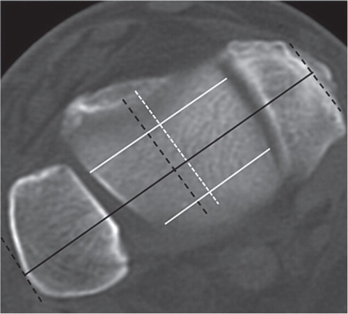 Figure 2. Axial CT scan depicting the intermalleolar distance (continuous black line) and its anterior projection (dotted black line). The white dotted line represents the center of the talar dome originating from the connection of 2 pints located in the middle of its anterior and posterior region (white continuous lines). Note that the center of the intermalleolar distance (dotted black line) is translated laterally with respect to the center of the talar dome.