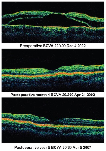 Figure 5 Good visual recovery with good anatomic outcome.