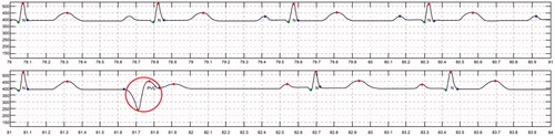 Figure 11. Automatic ECG detection results for premature ventricular contraction (PVC).