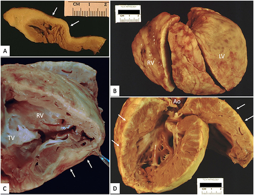 Figure 5 Cardiac explant with arrhythmogenic cardiomyopathy and left ventricular noncompaction. (A) Cross-section of right ventricular free wall with pale adipose tissue (white arrows) extending from epicardium, focally replacing all but subendocardial trabeculations. (B) External view of right (RV) and left (LV) ventricles with abundant epicardial adipose tissue. (C) Septal surface of right ventricle (RV) with extensive fibrofatty replacement (white arrows) of large portions of the free wall. (D) Left ventricle with extensive, deeply trabeculated myocardium and segmental areas of subepicardial fatty infiltration (white arrows).