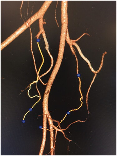 Figure 3. 3D CT Angiogram of pelvic arteries processed on Siemens Syngo Embolization Guide platform. Left IPA pathway is highlighted correctly, while right IPA pathway was divergent and had to be adjusted manually.