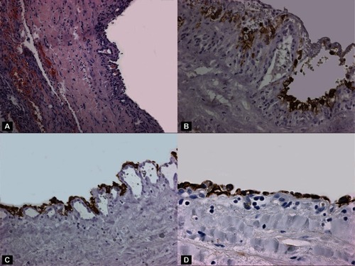 Figure 2 A) The cystic wall was lined by cuboidal epithelial cells (H&E stain, 80×). B) The epithelial cells were immunoreactive with EMA (EMA stain; original magnification, 160×). C) A strong immunopositivity was found also with CK AE1/AE3 (CK AE1/AE3 stain; original magnification, 80×). D) CK18 revealed an evident immunostaining in cuboidal epithelial cells (D) (CK AE1/AE3 stain; original magnification, 160×).