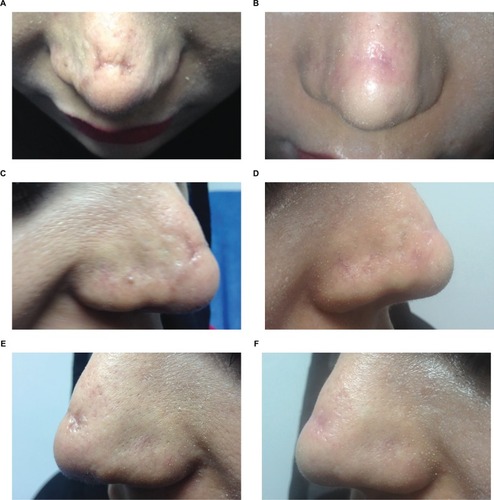 Figure 2 A 29-year-old female patient with recent postsurgical scar (rhinoplasty), before laser treatment (A, C, E) and 3 months after laser treatment (B, D, F).