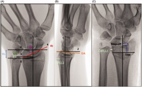 Figure 1. (A) Posteroanterior measurement guidelines: (1) The center of the radial shaft is determined at 3 cm and 5 cm below the mid-region of the proximal lunate articular surface. This line represents the central axis of the radius. (2) A line perpendicular to the central long axis of the radius is drawn at the level of the most distal aspect of the radial articular surface. (3) A line perpendicular to the central long axis of the radius is drawn at the level of the ulnar margin of the distal radial articular surface. (4) The radial and ulnar margins of the distal radial articular surface are connected. (5) A line perpendicular to the central long axis of the radius is drawn at the level of the distal ulnar articular surface. (B) Lateral measurement guidelines: (1) The center of the radial shaft is determined at 3 cm and 5 cm below the mid-region of the proximal lunate articular surface. This line represents the central long axis of the radius. (2) A line perpendicular to the central long axis of the radius is drawn at a convenient level. (3) The dorsal and anterior margins of the distal radial articular surface are connected. (C) Step-off and gap measurement. (1) Step-off at the articular surface of the distal radius was measured parallel to the central long axis of the radius by drawing perpendicular lines from the most distal margin of each side of the articular incongruence. (2) Gap deformity was measured along a perpendicular line to the central long axis of the radius. UV: ulnar variation; RL: radial length; RI: radial inclination; DT: dorsal tilt; SL: scapholunate ligament; DRUJ: distal radioulnar joint.