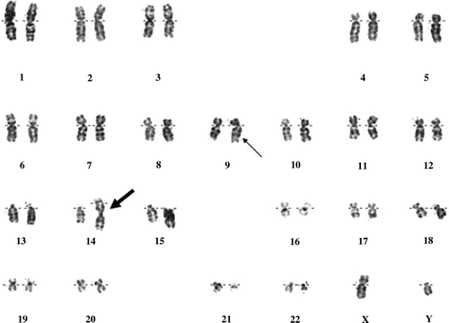 Figure 1.  G-banded karyogram from bone marrow cells of the patient showing trisomy 14 due to a Robertsonian translocation, normal and derivative chromosomes 9 and 22. Karyotype of the patient was noted as 46,XY,t(14;14)(q10;q10),t(9;22)(q34;q11.2). The Robertsonian translocation is indicated by the thick arrow and the Ph chromosome was marked with the thin arrow.
