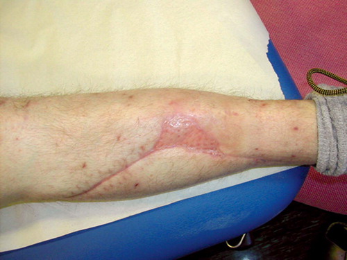 Figure 9. 2 months after split skin grafting.