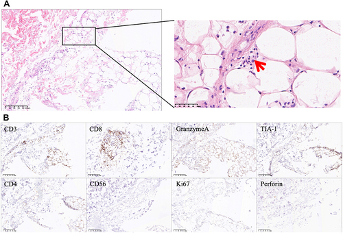 Figure 2 Hematoxylin-Eosin (HE) and immunohistochemical staining of skin biopsy. (A) HE staining showed histiocytophagy (“beanbag-like” cells, red arrow), degeneration of adipocytes within the fat lobules, infiltration with small mature lymphocytes and histiocytes. (B) Increased expression of CD3, CD8, GranzymeA and TIA-1, negative expression of CD4, CD56, Ki67 and Perforin in immunohistochemical staining. The scale bar is 200 μm for the 20X images.