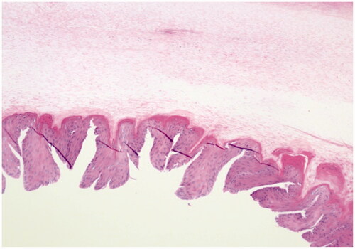 Figure 2. Sections demonstrate nail bed epithelial cells with abundant eosinophilic cytoplasm arranged in papillomatosis pattern with acanthosis and thickened fibrovascular stroma in the nail bed (H&E × 100).