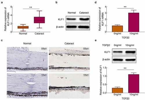 Figure 1. Stimulation of TGF-β2 activated the expression of KLF1 in human lens epithelial cells. (a, b) The expression of KLF1 in lens capsule tissues was detected with the RT-PCR and western blotting. (c) The expression of KLF1 in lens capsule tissues was detected by immunohistochemical staining. (d, e) The expression of KLF1 in human lens epithelial cells was detected with the RT-PCR and western blotting. * p < 0.05, ** p < 0.01, *** p < 0.001