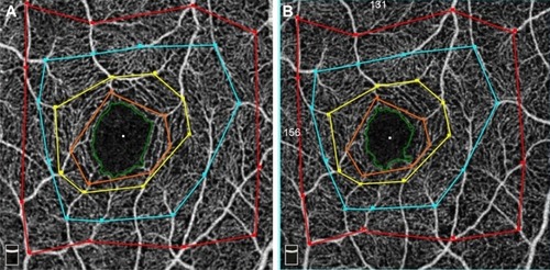 Figure 1 Pre- and postoperative OCTA image showing the FAZ and four polygonal areas surrounding the fovea.