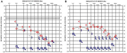 Figure 6 Initial and Post-Treatment Audiogram. (A) shows initial audiogram testing; red signifies right ear and blue the left ear. Word recognition was 0% when presented at 100 dB HL in the right ear and could not be tested in the left ear due to a lack of response. Right PTA was 62 dB HL, left ear could not be calculated. The right ear showed a moderate sloping to profound sensorineural hearing loss with very poor word understanding (0%). The left ear did not have any response to sound at the limits of testing. (B) shows 2-month repeat audiogram testing after plasma exchange and induction therapy. Word recognition was 53% when presented at 75 dB HL in the right ear and could not be tested in the left ear due to a lack of response. Right PTA was 52 dB HL, left ear could not be calculated. The right ear showed a moderate sloping to severe sensorineural hearing loss with poor word understanding ability (53%). The left ear did not have any response to sound at the limits of testing. The right ear improved an average of 10 dB PTA and showed partial recovery in word understanding ability. This significant improvement resulted in the patient being able to use amplification (hearing aids) successfully. The patient obtained BiCROS hearing aids to maximize her remaining auditory function.